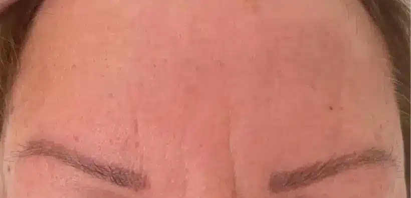 After - Anti wrinkle injections. Two areas treated - frown lines and forehead lines