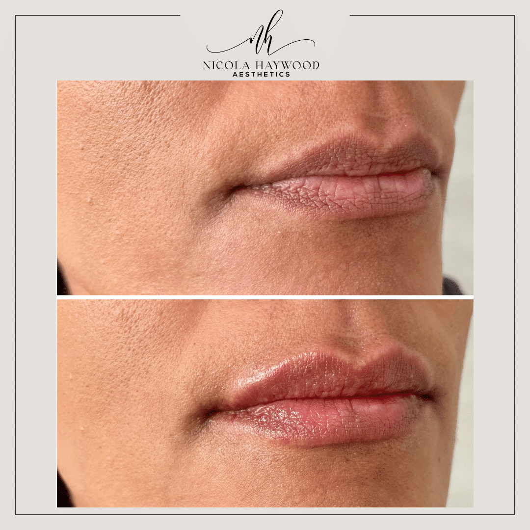 Lip Filler Wakefield for Over 35s