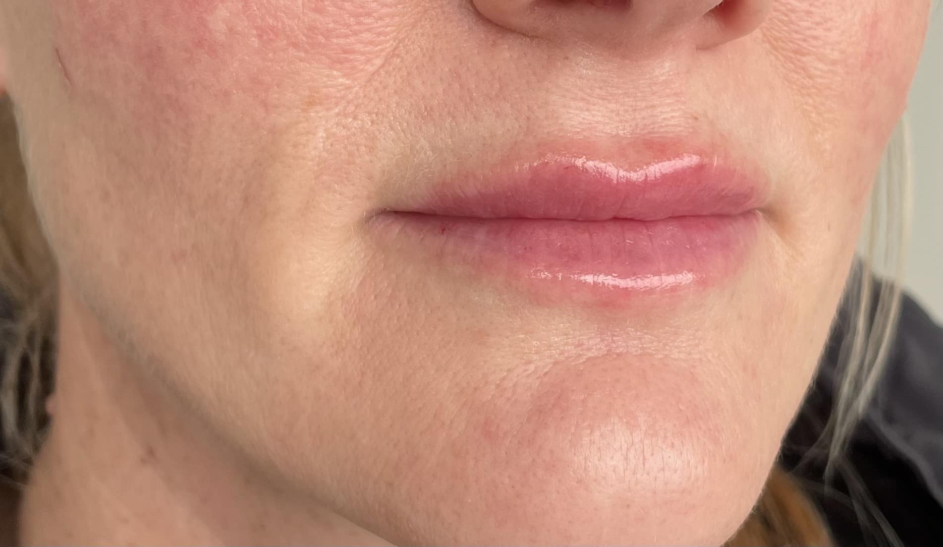 After Lip Filler
