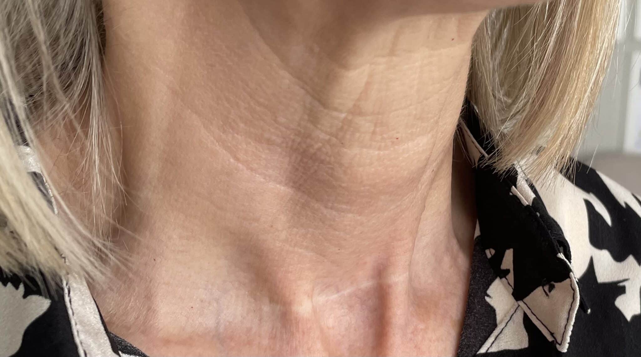 Before Profhilo Skin Booster Neck