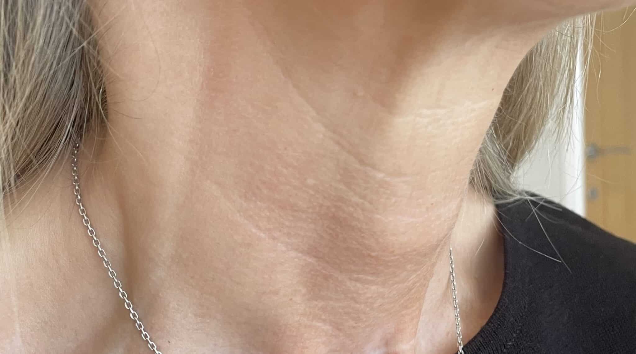 After Profhilo Skin Booster Neck