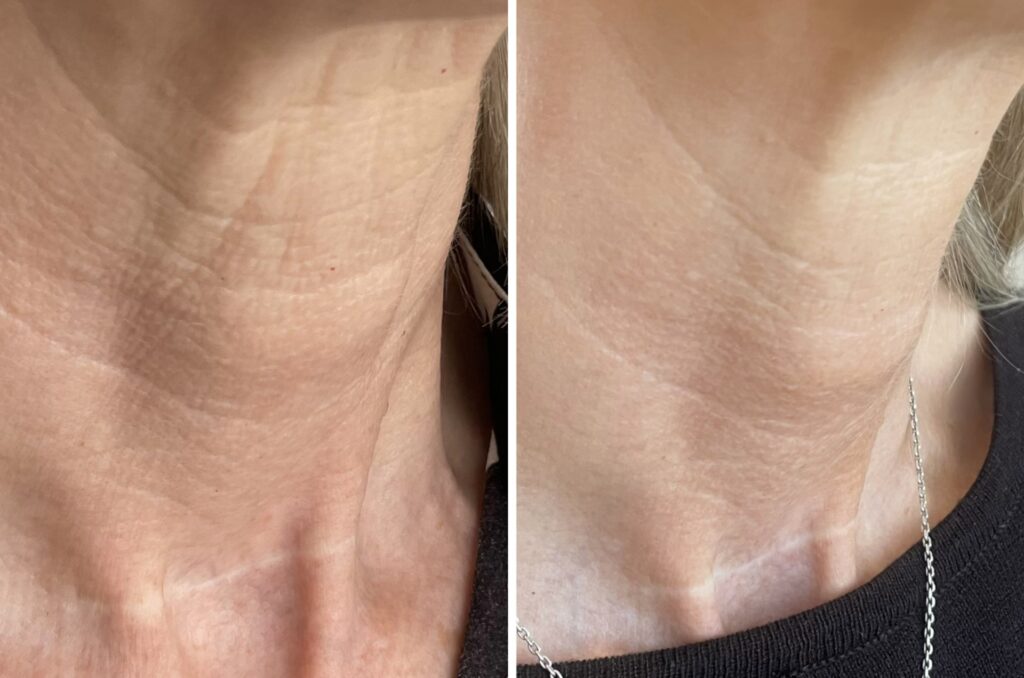 Profhilo treatment for the neck – before-and-after photos (comparative image)