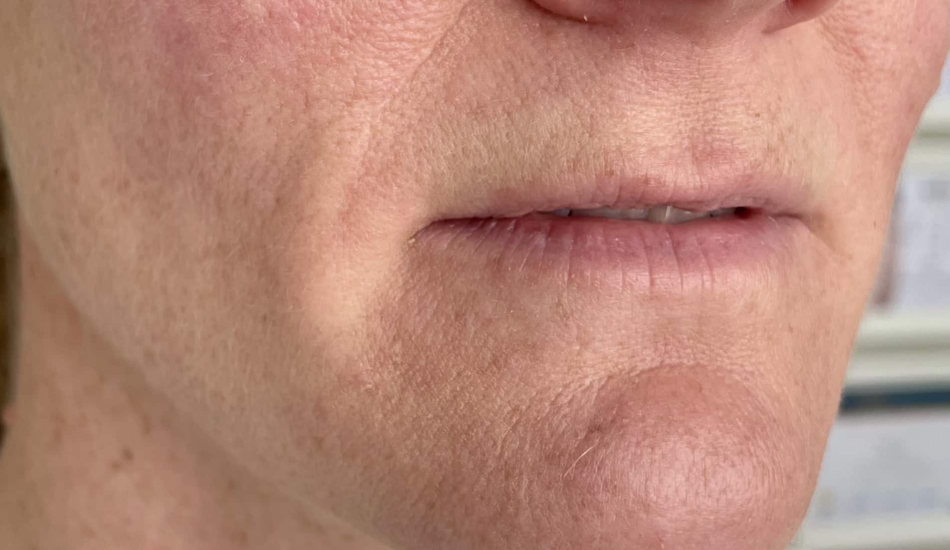 Before Lip Filler