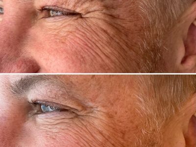 mens crows feet anti wrinkle treatment