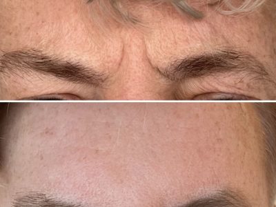 mens forehead anti wrinkle treatment