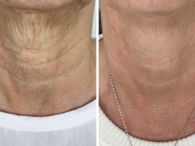 neck treatments