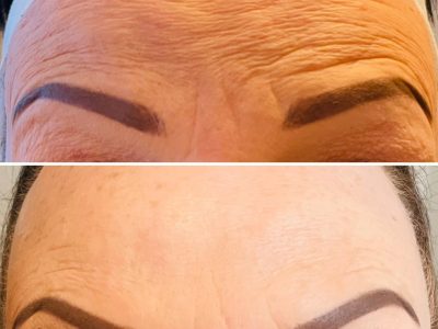 Anti Wrinkle treatments