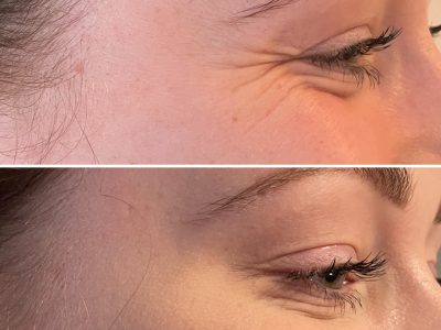 Anti Wrinkle