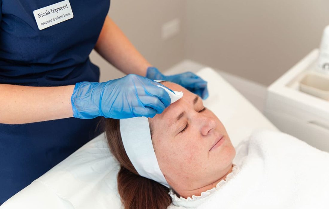 Chemical peel Wakefield