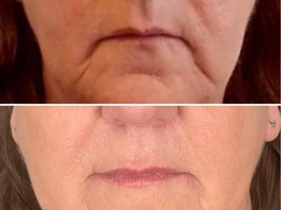 Nicola Haywood Aesthetics dermal filler treatment Wakefield