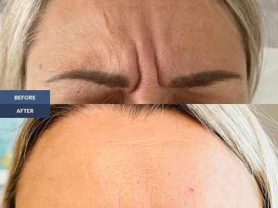 Frown lines before and after