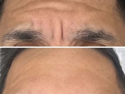 mens forehead anti wrinkle treatment