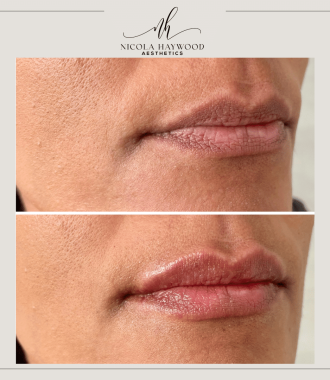 Lip Filler Wakefield for Over 35s