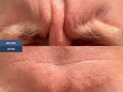 before and after mens anti wrinkle treatment