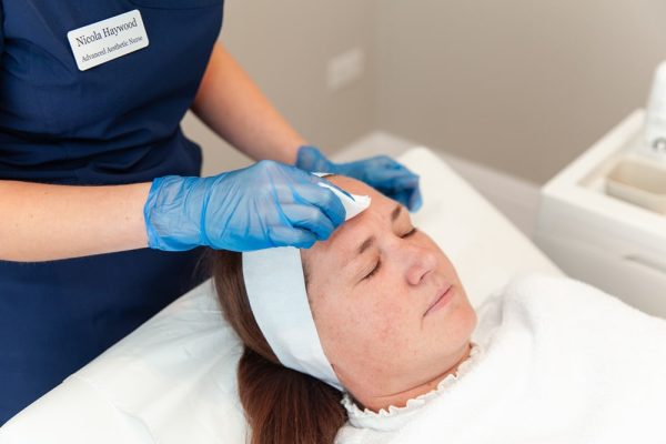 chemical skin peel