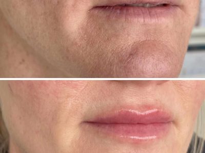 Three-stage lip filler journey showing a gradual approach to natural-looking lip enhancement.