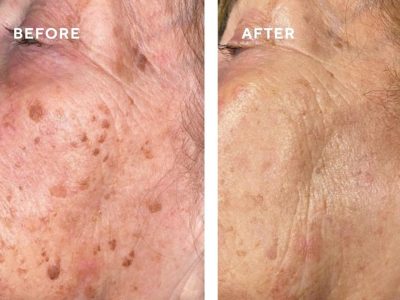 cryotherapy before and after age spots treatment