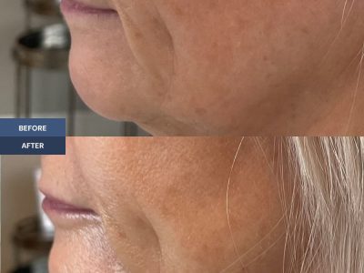 marionette lines before and after