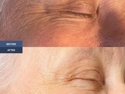 microneedling before and after