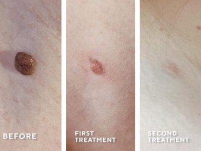 moles before and after cryotherapy treatment