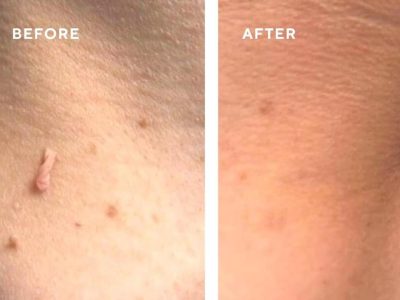 skin tag removal before and after cryotherapy treatment