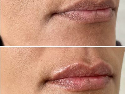 Natural lip filler at Nicola Haywood Aesthetics Wakefield